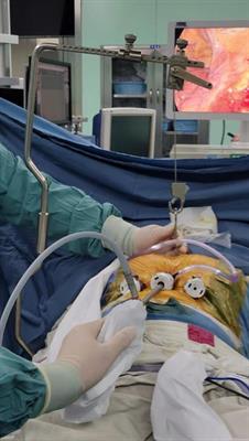 Modified subxiphoid approach for surgical resection of a retrosternal goiter